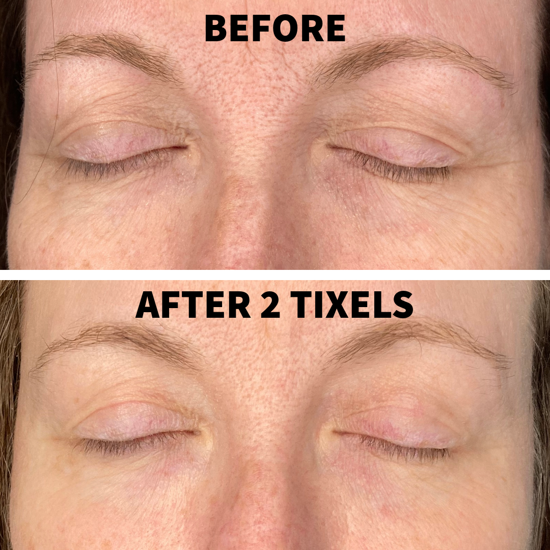 A "Before and After" comparison of a woman's closed eyes. The "After 2 Tixels" image shows a significant smoothing of fine lines on the upper eyelids and a reduction in the "crepey" texture of the skin compared to the "Before" image.
