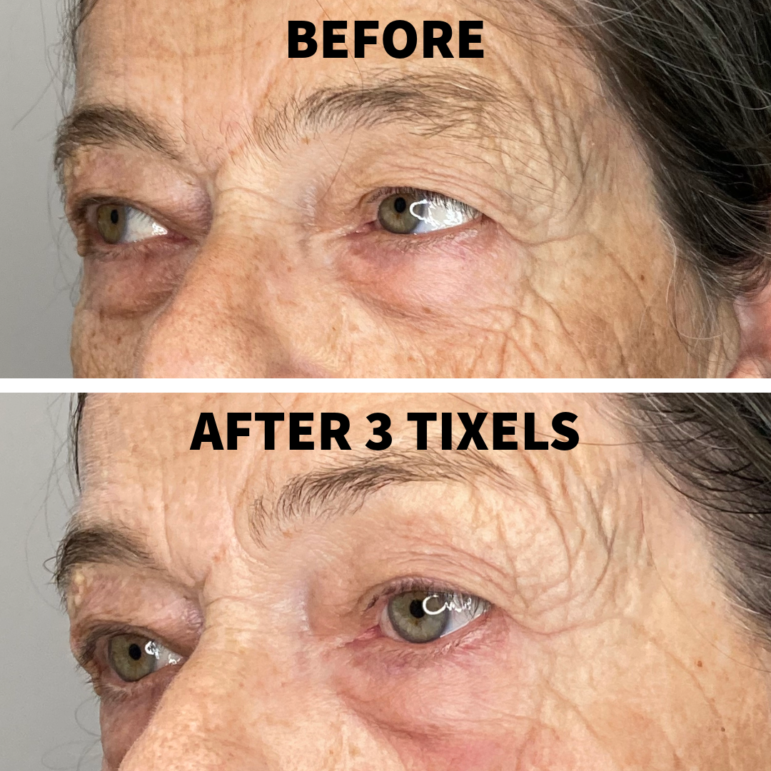 A "Before and After" side-profile view of an older woman’s eye area. The "After 3 Tixels" image demonstrates a visible tightening of the skin on the temple and upper cheek, with deep-set wrinkles and crow's feet appearing much softer and less pronounced.