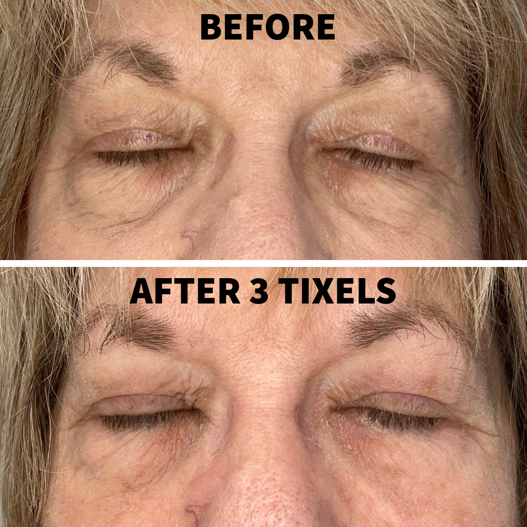 A "Before and After" comparison focused on the upper and lower eyelids of a woman with her eyes closed. The "After 3 Tixels" photo shows a firmer appearance of the eyelid skin and a reduction in the heavy folding or sagging (hooding) seen in the "Before" photo.