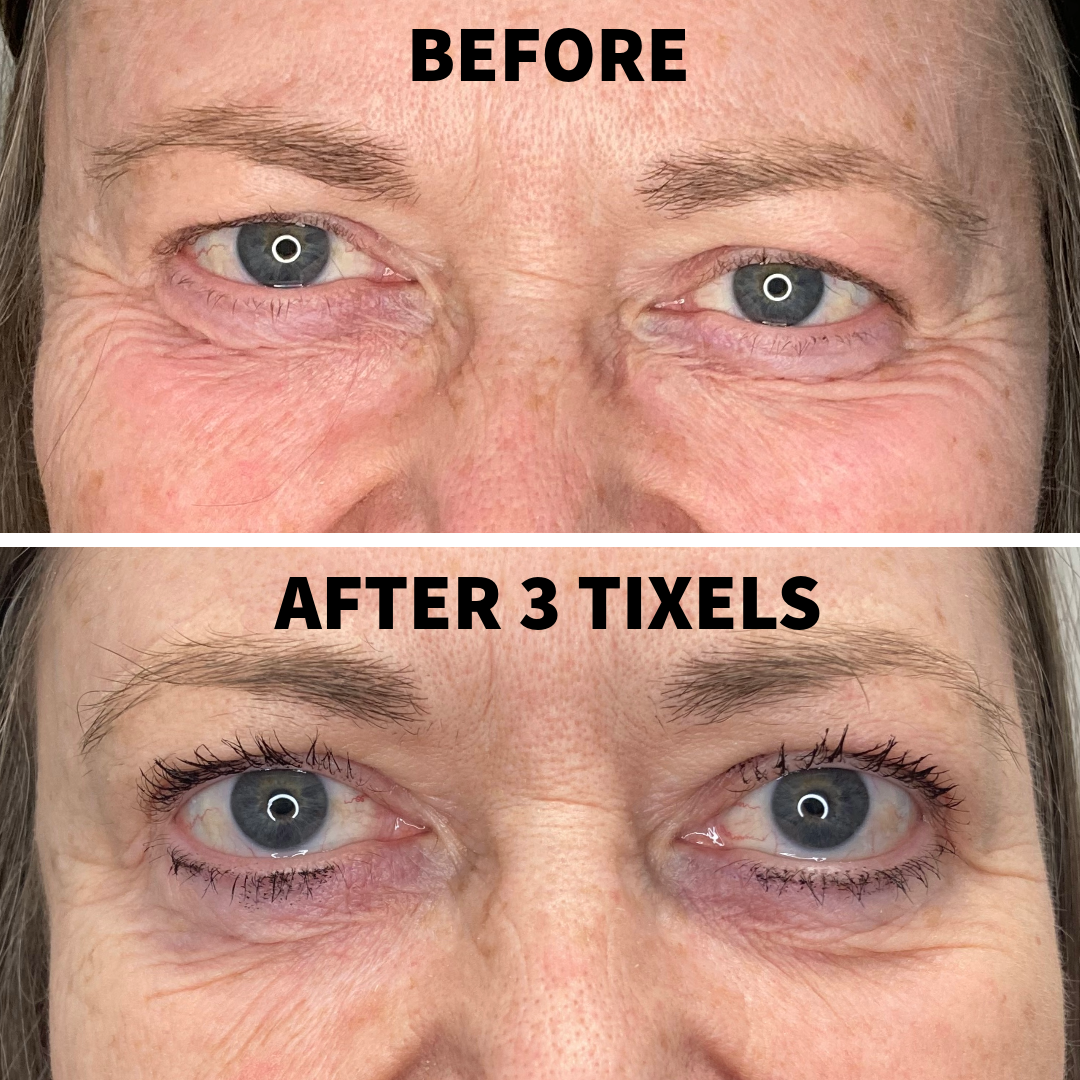 A "Before and After" comparison of a woman with her eyes open. The "After 3 Tixels" image shows a more "refreshed" look, with noticeably tighter skin under the lower lash line and a reduction in puffiness and fine lines around the corners of the eyes.